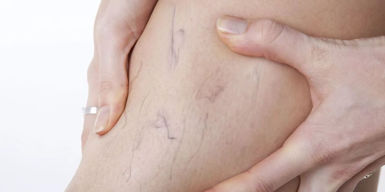 Pred použitím krému na varikón